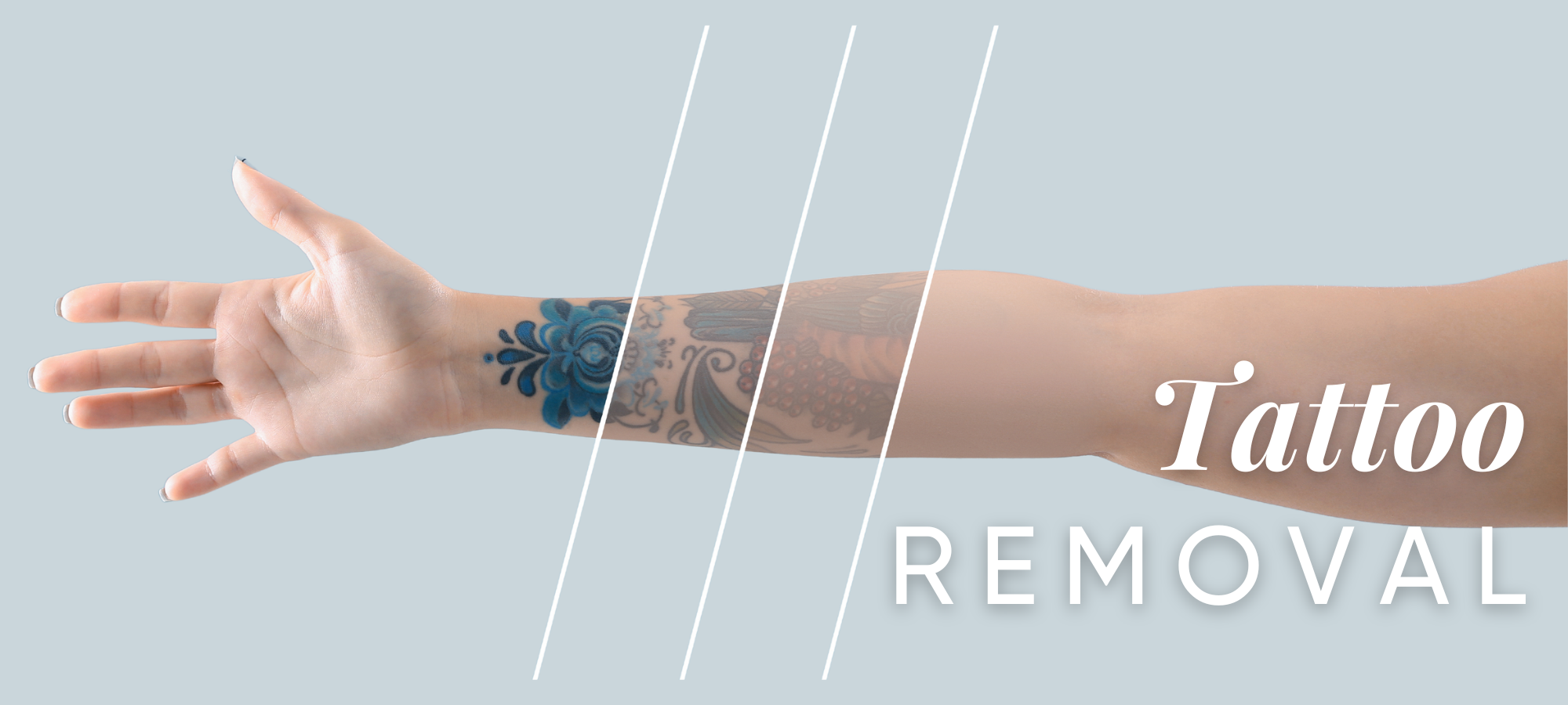 Laser Tattoo Removal - Michael Da Bear | Groupon